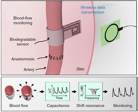 Wireless Blood Flow Sensor Wraps Around Arteries Self Resorbs