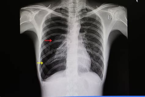 Chest Film Of A Patient With Large Pneumothorax Stock Image Image Of