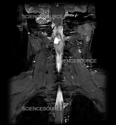 Mri Cervical Spinal Cord Astrocytoma Stock Image Science Source