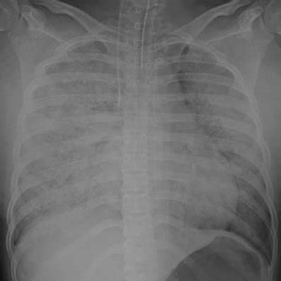 The Patient S Chest X Ray On Admission To The Intensive Care Unit