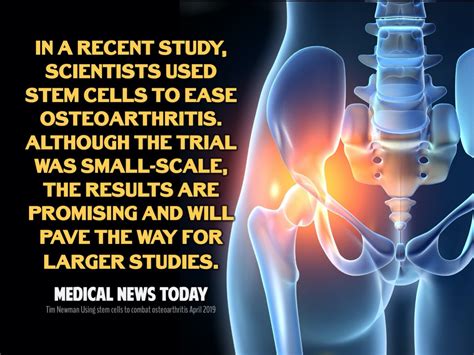 Stem Cell Therapy For Arthritis Peter A Fields MD DC