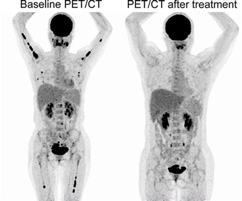 Uterine Burkitt Lymphoma With Rare Extranodal Deposits Ott