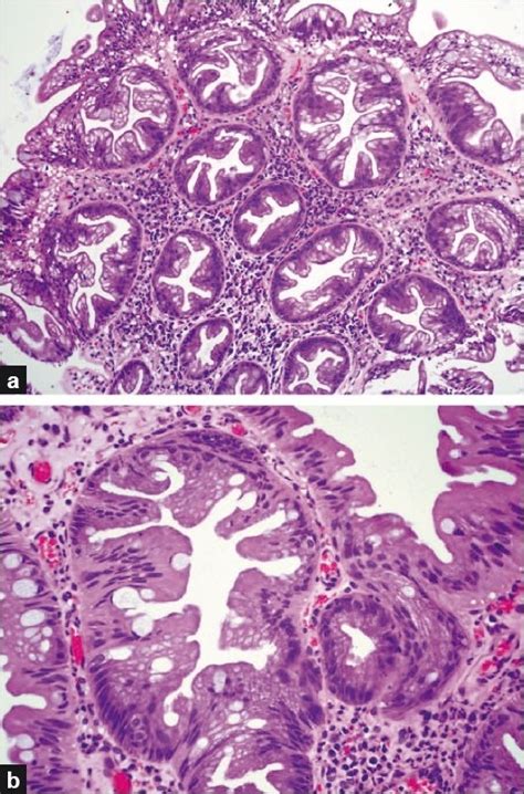 Showing 4 Serrated Polyp Subtypes A Microvesicular