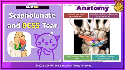 Wrist02 Scapholunate Ligament Tear And Dorsal Capsulo Scapholunate