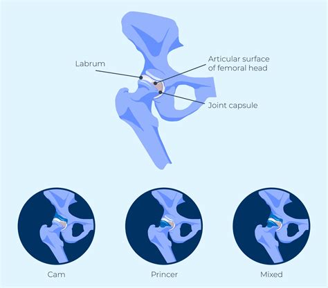 Femoroacetabular Impingement Fai Hip Impingement Orthopedic Hip