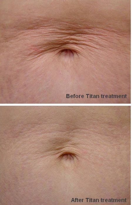 Titan™ Laser Light Procedure Uses Infrared Technology To Tighten Skin