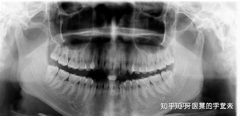 智齿一定要拔吗拔完对面型有影响吗 知乎