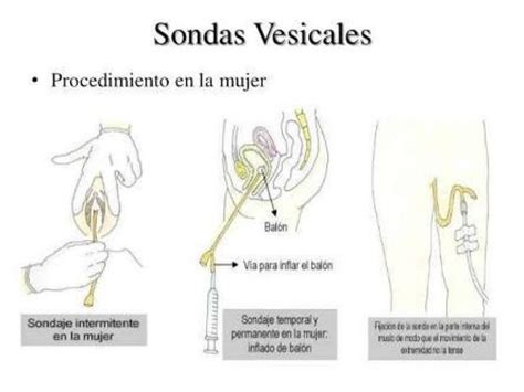 The Diagram Shows How To Use An Inhaler For Vagination And Removal