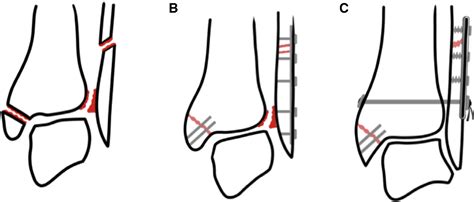 Figure 1 From Distal Tibiofibular Syndesmosis Dysfunction A Systematic