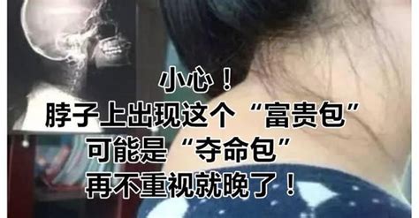 脖子後有個「富貴包」？它不「富貴」，而是健康向你發出的「危機警告」！ 每日頭條