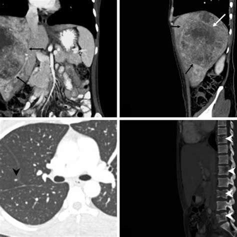 Preoperative CT scan: mucosal thickening in the sphenoethmoidal recess... | Download Scientific ...