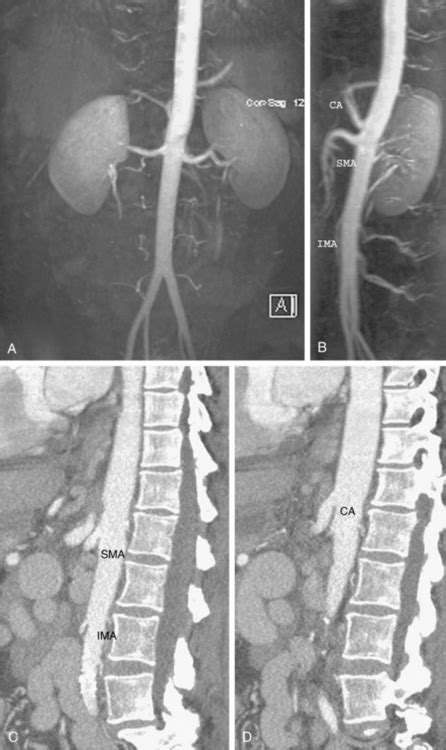 Abdominal Aortic Aneurysm Lateral Xray