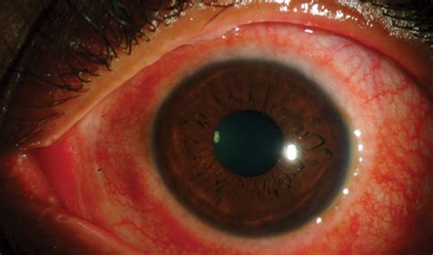 An Atlas of Conjunctival and Scleral Anomalies