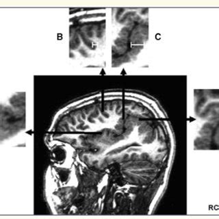 MRI features of atypical and rare patterns of polymicrogyria. All ...