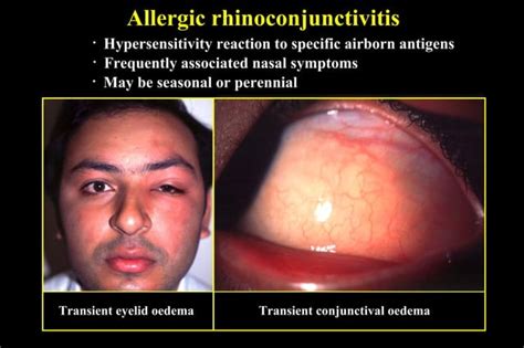 10 Allergic Conjunctivitis Ppt