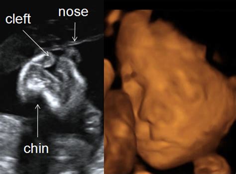 Cleft Lip 3d Ultrasound