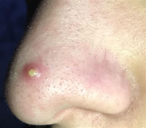 Pimple on the nose, does it heal faster by just letting it be or by popping it cleanly? : r/acne