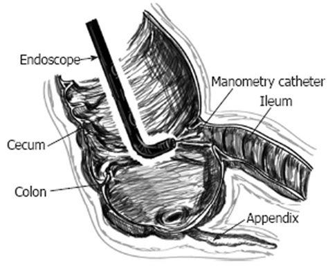 Ileocecal Valve Model