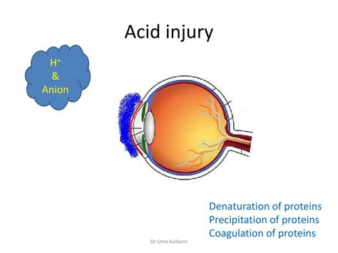 Ppt Classification Of Ocular Injuries Powerpoint Presentation Free Download Id 9710159