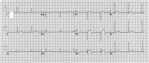 ECG pattern of Wellens syndrome-type A Slika 3. Elektrokardiogram ...