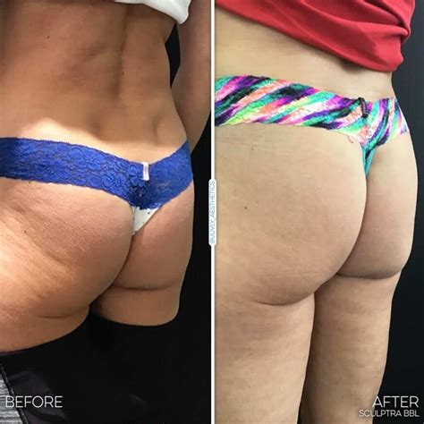 Juvly Aesthetics Sculptra Body Contouring For Brazilian Butt Lift