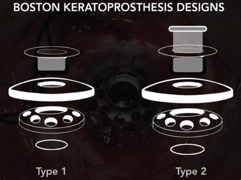 Crstoday Type Boston Keratoprosthesis For End Stage Ocular