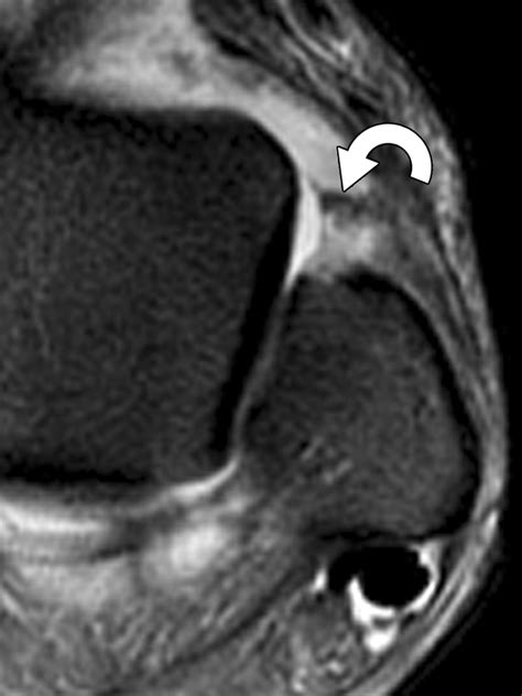 Lateral Ankle Ligaments Mri