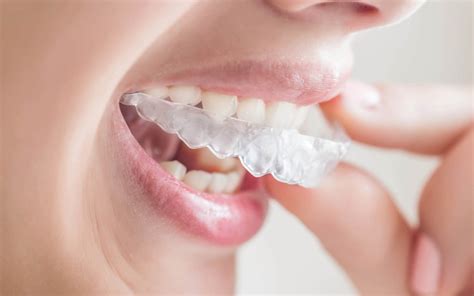 Invisalign® Braces in Cincinnati, OH | Boley Braces