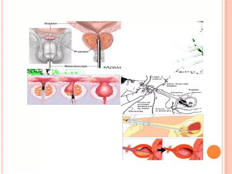 Nursing Transurethral Resection Of The Prostate Ppt