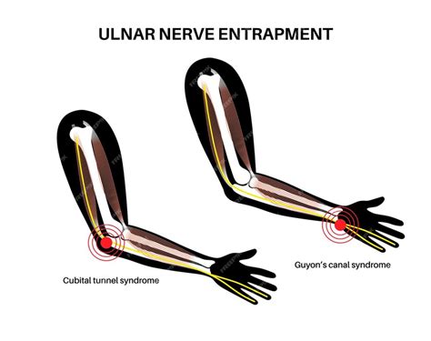 Premium Vector | Ulnar nerve entrapment