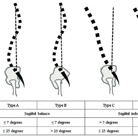 Four Grades Of Sagittal Global Balance Defined By Spinal Tilt Angle And