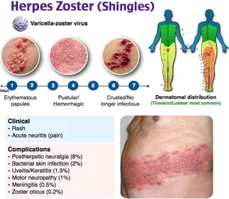 Herpes Zoster Flashcards Quizlet