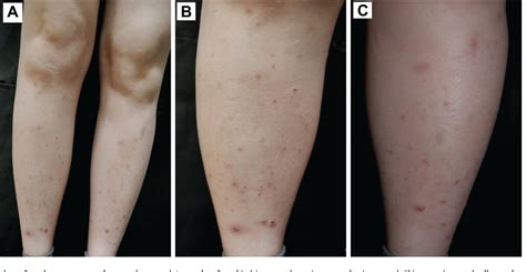 Figure 4 From Palisaded Neutrophilic And Granulomatous Dermatitis