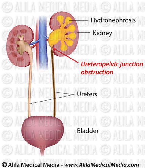 Alila Medical Media Ureteral Stricture Unlabeled Medical Illustration