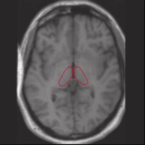 Segmentation Of The Thalamus Figure 2 Segmentation Of The Thalamic