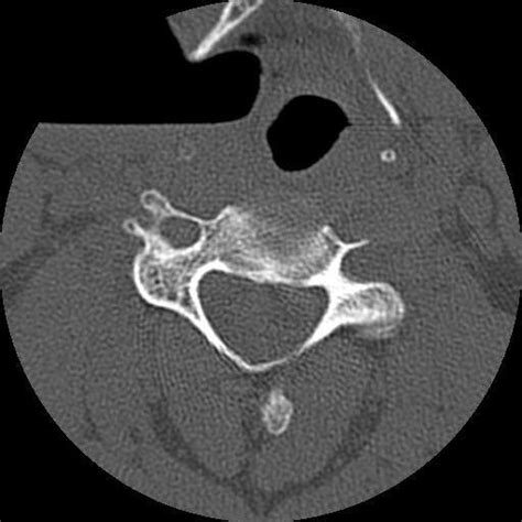 Plain X Ray Neck Showing Air Filled Space In The Soft Tissue Neck On Download Scientific