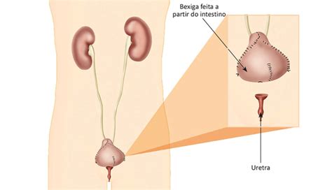 Deriva Es Urin Rias Hospital Amaral Carvalho Urologia Ja