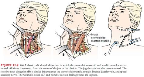 Neck Dissection