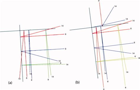 Cephalometric Superimposition on the Occipital Condyles as a Longitudinal Growth Assessment ...