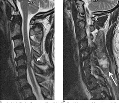 Figure 3 from Cervical facet joint septic arthritis: a case report ...