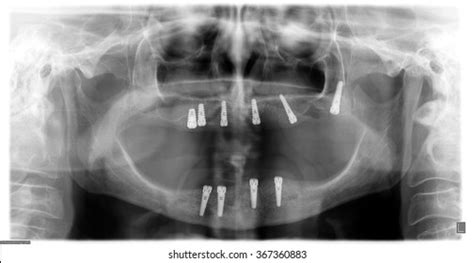 Dental Implant Xray Royalty-Free Images, Stock Photos & Pictures ...