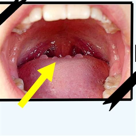 Cómo Quitar Llagas del fondo de la LENGUA Enfermedades de la lengua