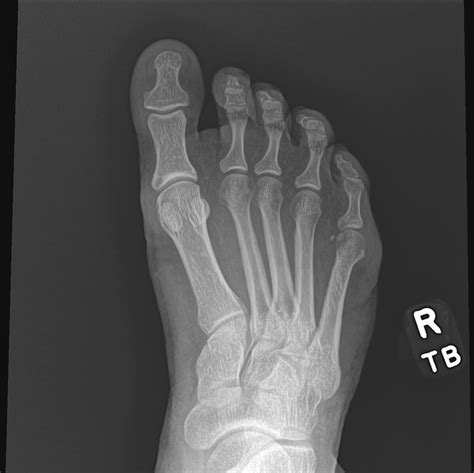 OrthoDx: Sore Bump on Side of Foot - Clinical Advisor