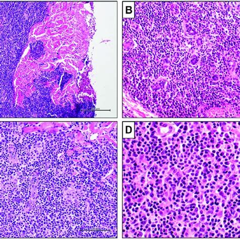 Primary Cutaneous Marginal Zone Lymphoma Immunohistochemical Findings