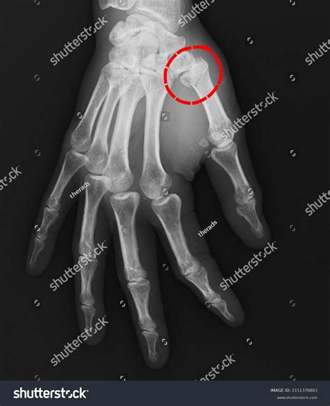 Bennetts Fracture Break Base Your Thumb Stock Photo 2151378883