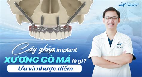 Cấy ghép Implant xương gò má là gì Có ưu và nhược điểm gì