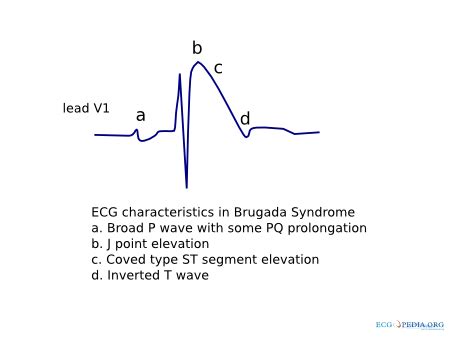 Brugada Syndrome Ecgpedia