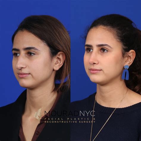 Before And After Female Rhinoplasty Facial Plastic Surgeon