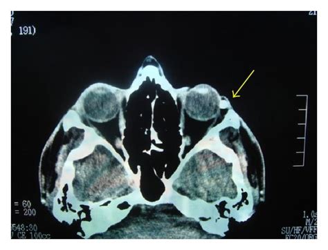 Episcleral Osseous Choristoma On The Lateral Canthus Of Left Eye In