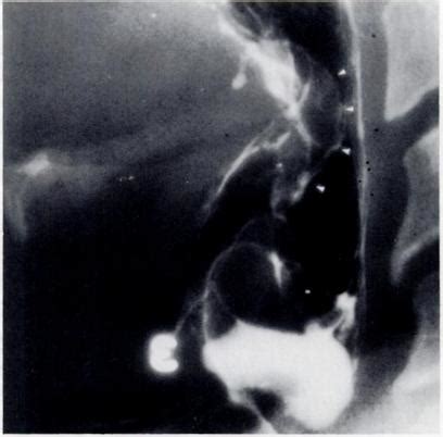 A laryngogram shows a thickened epiglottis (arrowheads) and distortion ...